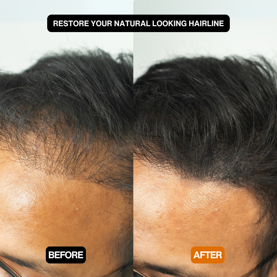 Hair Density Filler